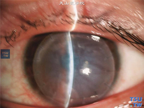 同一患者，裂隙灯显微镜检查，可见角膜植片基质弥漫性混浊，混浊密度不均，内皮界面不清