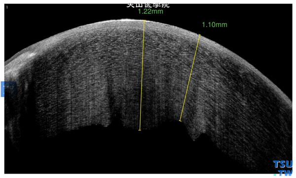 同一患者，RTvue OCT检查，显示角膜植片高度水肿、增厚，影像密度不均，上皮层水肿，有微细的水泡，内皮面凹凸不平