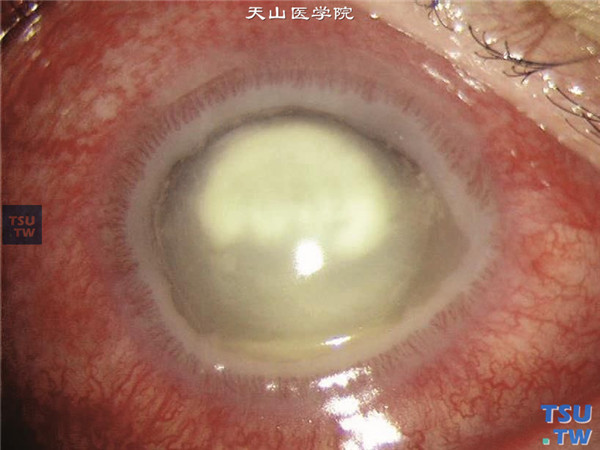 患者，男，33岁，双眼红痛、视力下降8个月，右眼视物不见7天，患者3年前因“白血病”行“骨髓移植术”，体格检查，皮肤干燥、增厚、硬化，色素沉着，头部脱发，眼部检查可见眼表干燥，泪河消失，全角膜水肿混浊，角膜上皮缺损，角膜周边自溶变薄呈沟状，前房积脓，诊断为移植物抗宿主病