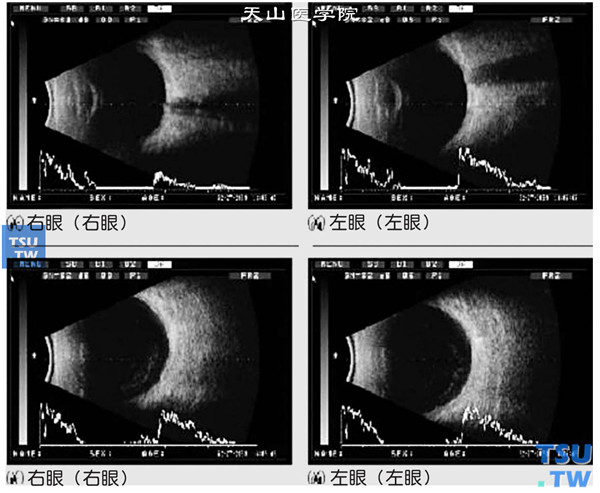 双眼B型超声检查，可见玻璃体混浊，疑诊化脓性眼内炎