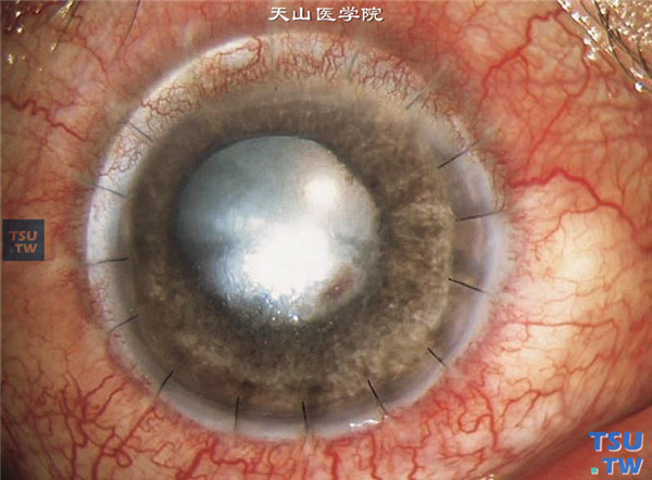 右眼行穿透角膜移植术联合玻璃体腔注射万古霉素注射液治疗，术后1个月，可见角膜植片透明，晶状体混浊