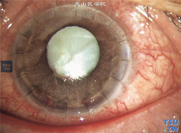左眼行穿透角膜移植术联合玻璃体腔注射万古霉素注射液治疗，术后1个月，可见角膜植片透明，晶状体混浊，眼压升高，药物不能控制