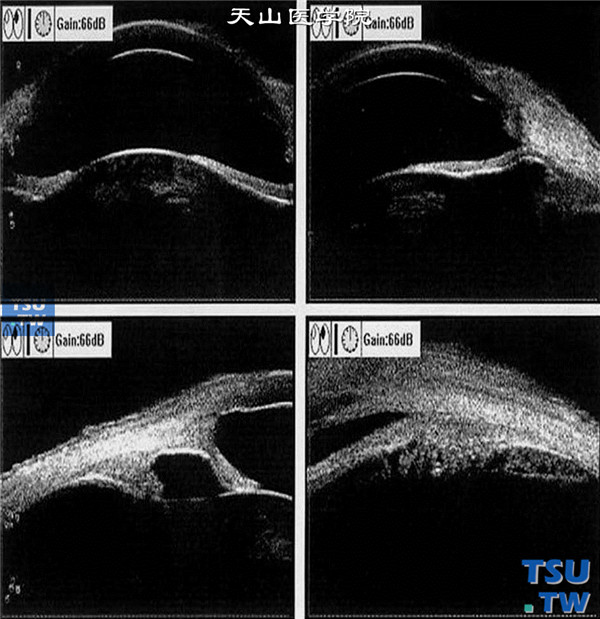左眼超声活体显微镜（UBM）检查，可见各个方向虹膜前粘连，房角关闭，晶状体混浊，位置前移