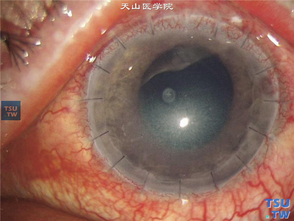 左眼ECCE联合小梁切除术，术后7天，矫正视力0.3，眼压正常