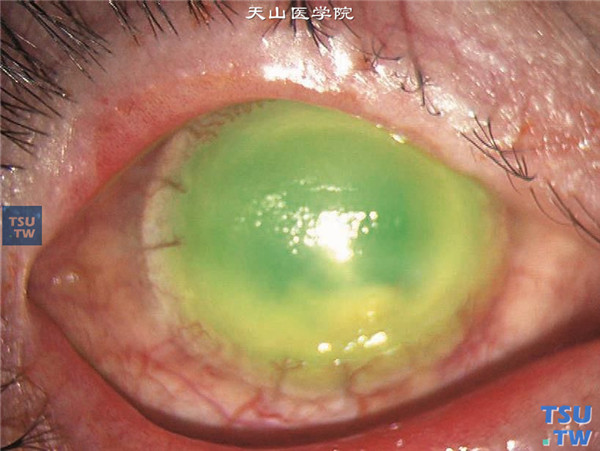 右眼术后18个月，患者再次发生视物模糊，检查发现角膜植片溃疡，荧光素钠染色阳性