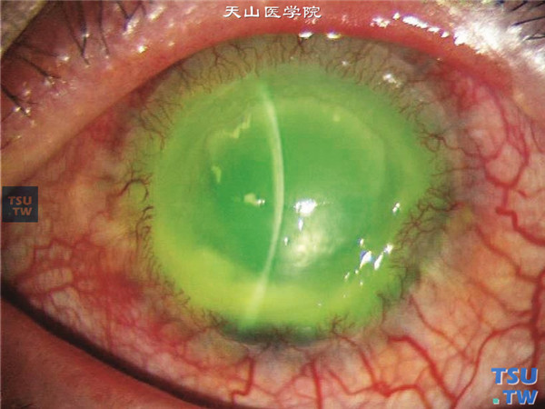 左眼角膜发生了同样病变，可见混合充血，角膜植片溃疡，新生血管长入，荧光素钠染色阳性