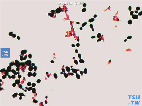 角膜病灶刮片，标本涂片染色后可见大量真菌孢子，并可见出芽现象。鉴定为季也蒙假丝酵母菌 革兰染色 ×1000