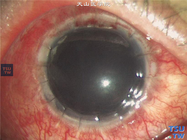 右眼再次行穿透角膜移植术，术后15天，角膜植片透明，矫正视力0.2
