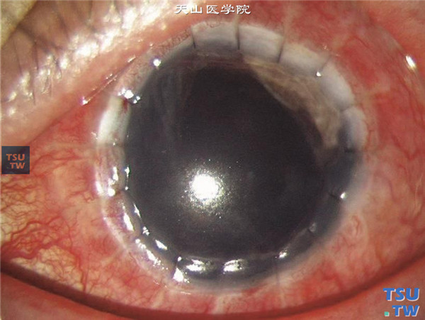 左眼也再次行穿透角膜移植术，术后7天，可见角膜植片透明，矫正视力0.1