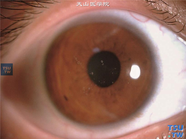 颗粒状角膜营养不良，患者15岁，右眼表现为中央区角膜浅基质层散在的雪花样混浊，无炎症表现