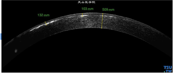 颗粒状角膜营养不良，上图同一患者，右眼RTvue OCT检查，角膜浅基质层混浊，表现为高密度影像，角膜基质密度均匀，无炎性表现，上皮层和内皮层完整