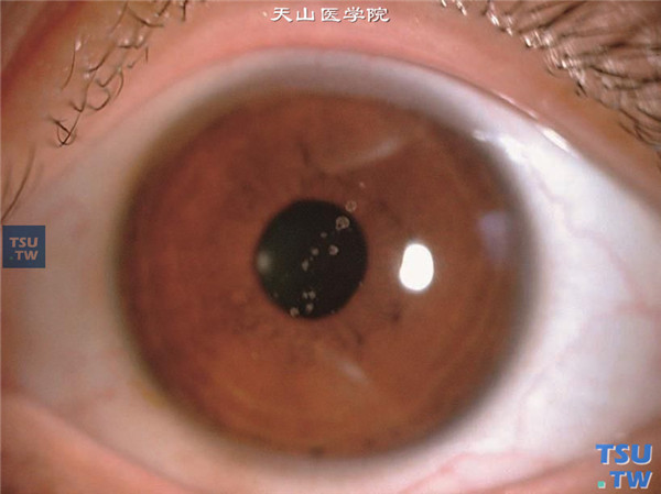 颗粒状角膜营养不良，上图同一患者左眼，也为中央区角膜浅基质层散在的雪花样混浊，无结膜充血