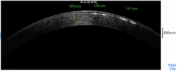 左眼RTvue OCT检查，表现为与右眼完全相似的影像学改变，混浊在浅基质层