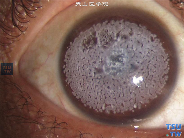 角膜基质层：颗粒状角膜营养不良及症状图解