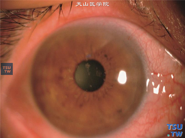颗粒状角膜营养不良Ⅱ型，患者发病年龄55岁，角膜浅基质层仅见散在面包屑样混浊，视力无影响，结膜轻度充血