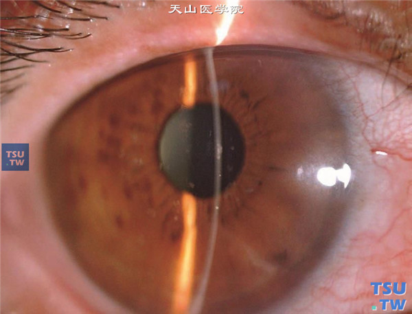 颗粒状角膜营养不良Ⅱ型，上图同一患者，裂隙灯显微镜检查，显示角膜小的片状混浊，位于角膜的浅基质层，角膜厚度均匀