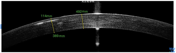 颗粒状角膜营养不良Ⅱ型，上图同一患者，RTvue OCT 检查，可见角膜浅基质层片状混浊