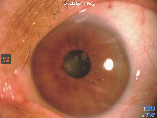  颗粒状角膜营养不良Ⅱ型，上图同一患者左眼，可见角膜中央区浅基质层也有雪花状混浊，结膜轻度充血