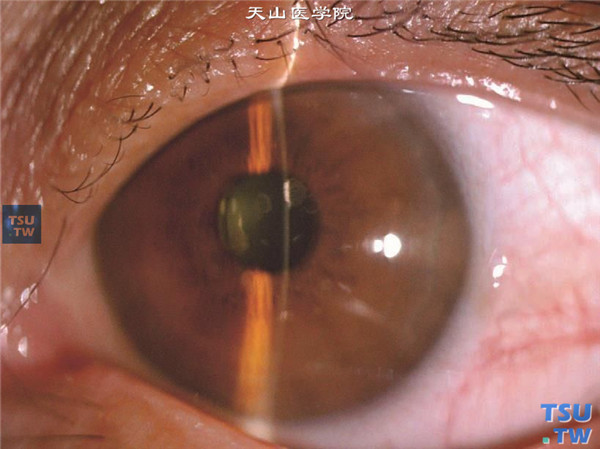 左眼裂隙灯显微镜检查，可见角膜片状混浊，位于浅基质层，角膜厚度均匀
