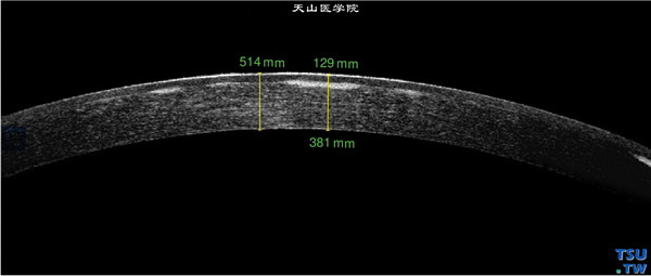 左眼RTvue OCT检查，显示角膜片状混浊位于角膜浅基质层，角膜基质影像密度均匀，上皮层和内皮层完整