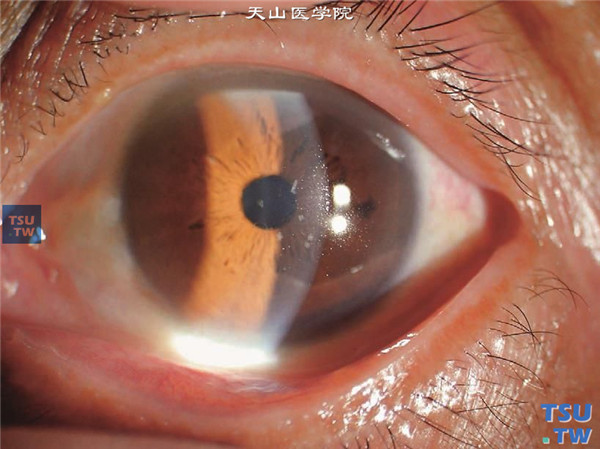 颗粒状角膜营养不良Ⅲ型，患者发病年龄66岁，可见角膜中央区浅基质层少量散在孤立的片状混浊，患者无症状