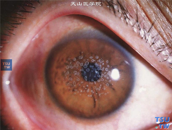 颗粒状角膜营养不良，角膜中央区浅基质层面包屑样混浊，视力受累