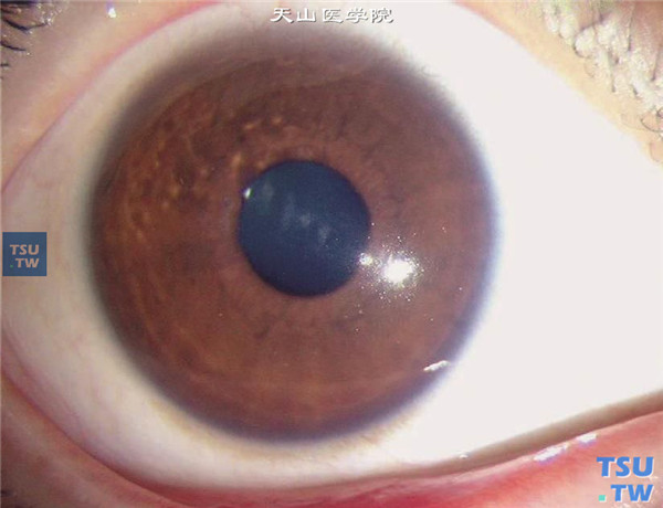 颗粒状角膜营养不良，上图同一患者行PTK治疗，视力明显改善，术后随访6个月，角膜仍保持手术结束时的透明度，无复发迹象