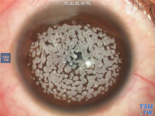 颗粒状角膜营养不良，角膜中央区基质层混浊互相融合，呈圆盘状花纹
