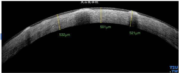 斑块状角膜营养不良，同一患者，RTvue OCT检查，可见斑块状混浊在角膜基质内呈现结节样致密影像，角膜上皮层完整