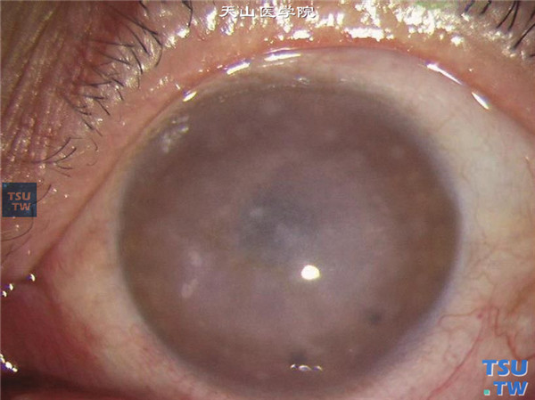斑块状角膜营养不良，上图同一患者左眼，角膜和右眼相似的斑块状混浊