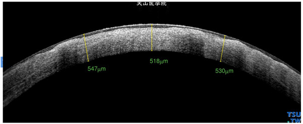 斑块状角膜营养不良，上图左眼，RTvue OCT检查，可见角膜基质内呈现密度不均、凹凸不平的影像，角膜上皮层完整，内皮层影像欠均匀和连续