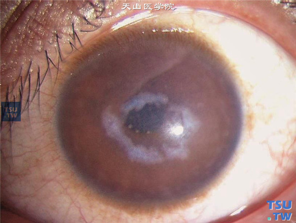 斑块状角膜营养不良，随着病情发展，形成角膜中央区环形混浊