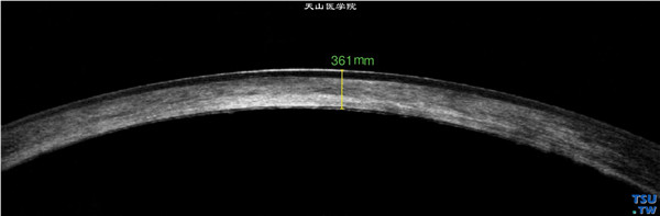 斑块状角膜营养不良，上图同一患者，RTvue OCT检查，显示角膜基质层密度不均匀的混浊影像，中央角膜厚度为361mm，上皮层完整，内皮层影像欠均匀和连续