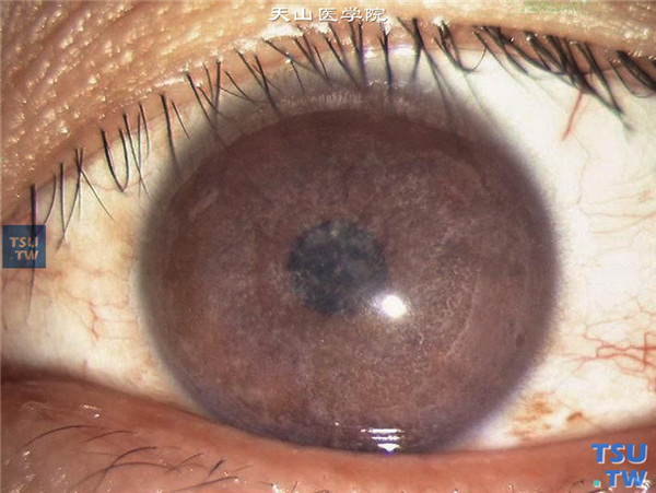 斑块状角膜营养不良，上图患者左眼，角膜基质层混浊同右眼相似
