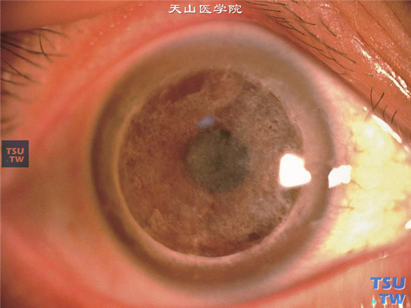 斑块状角膜营养不良同一家系，患者为第一代，女，58岁，右眼行穿透角膜移植手术治疗，术后随访9年，植片呈斑块状混浊，病情复发