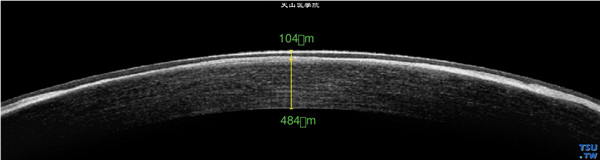 斑块状角膜营养不良者右眼 RTvue OCT检查，显示复发部位位于角膜浅基质层内，呈厚度不均的高密度影像