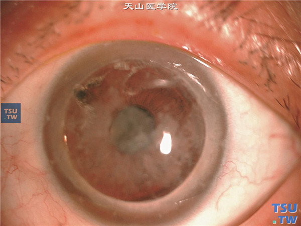 斑块状角膜营养不良，上述患者左眼，行穿透角膜移植治疗，术后随访9年，同样复发