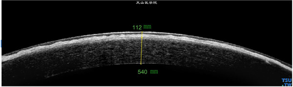 斑块状角膜营养不良，上述患者左眼RTvue OCT检查，角膜基质层不均匀混浊，呈厚度不均的高密度影像，上皮层和内皮层完整