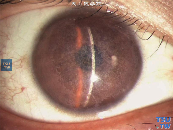 斑块状角膜营养不良同一家系，患者为第二代，男，36岁，右眼角膜基质层斑块状混浊