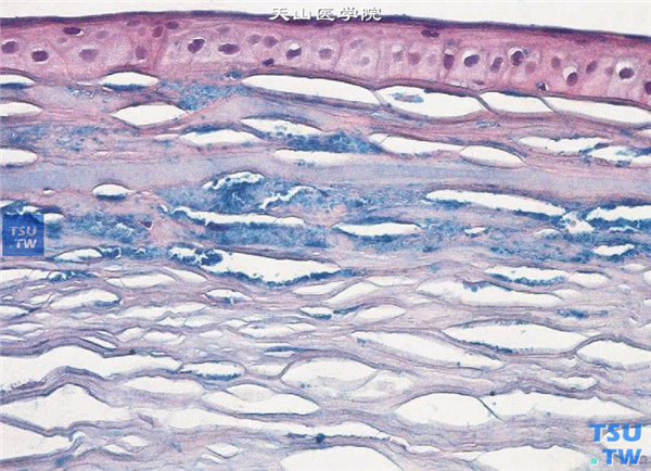 胶性铁染色×400 上述两张图片，显示斑块状角膜营养不良，从术中获取病变角膜片行组织病理学检查，显示前弹力层被破坏，角膜上皮下及基质层内可见黏蛋白物质沉积，胶性铁染色，黏蛋白呈蓝色