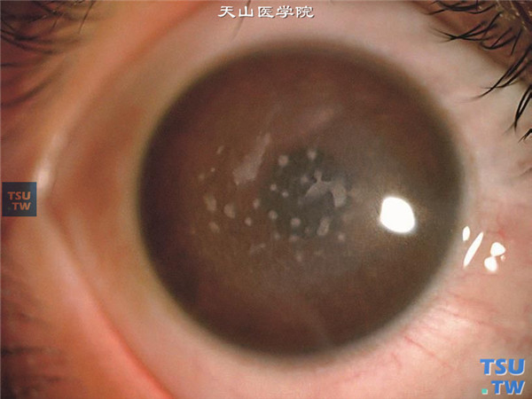  斑块状角膜营养不良，右眼角膜基质斑块状混浊