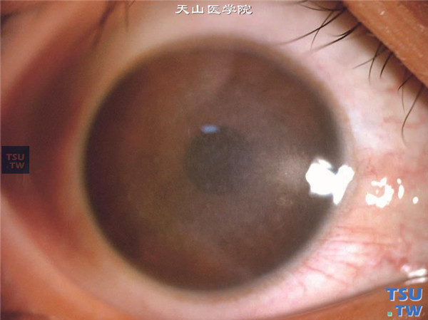 斑块状角膜营养不良，右眼PTK治疗后5个月，视力较术前无明显改善，裸眼视力0.06，角膜雾状混浊