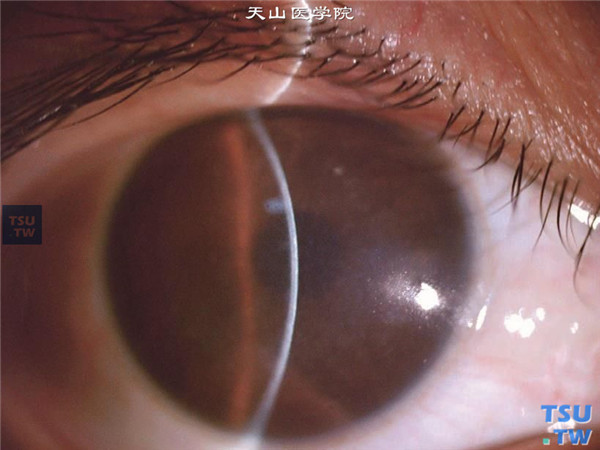 斑块状角膜营养不良，右眼裂隙灯显微镜检查，可见角膜基质密度不均的混浊，中央角膜变薄