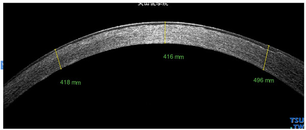斑块状角膜营养不良，右眼RTvue OCT检查，可见角膜弥漫性高密度影像，达角膜深基质层，角膜上皮层和内皮层影像完整，角膜变薄