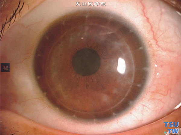 斑块状角膜营养不良，同一患者，左眼因斑块状角膜营养不良行板层角膜移植术治疗，术后随访2.5年，裸眼视力0.3，角膜植片透明，植床轻度混浊，无复发