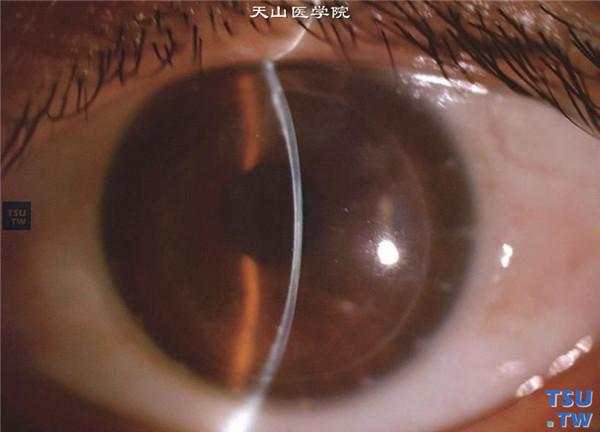 斑块状角膜营养不良，左眼裂隙灯显微镜检查，可见角膜植片基本透明，角膜植床轻度混浊