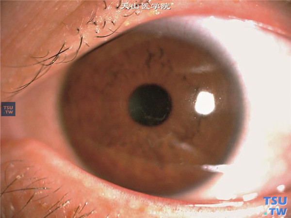 格子状角膜营养不良，早期就诊，仅见角膜中央区有轻度格子样混浊，视力不受累