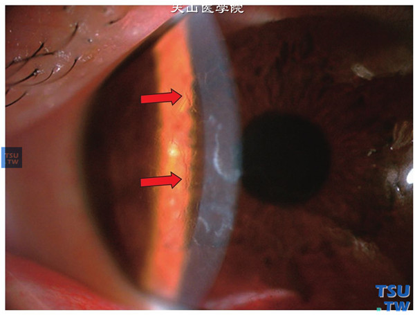 格子状角膜营养不良，同一患者，裂隙灯显微镜检查，可见角膜条格样混浊，位于角膜基质内，角膜、角膜上皮和内皮光滑，间接照明法可见角膜栅条样改变（箭头标示处）