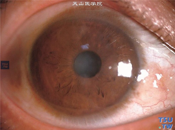 格子状角膜营养不良，裂隙灯显微镜大体观，右眼仅见角膜中央区有轻度混浊，裸眼视力0.15