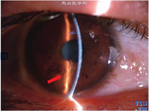 格子状角膜营养不良，同一患者，右眼裂隙灯显微镜检查，可见角膜基质不均匀混浊，间接照明法检查，可见角膜条格状混浊（箭头标示处）